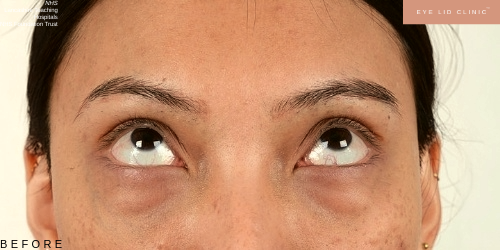 BEFORE LOWER BLEPHAROPLASTY EYE BAG REMOVAL